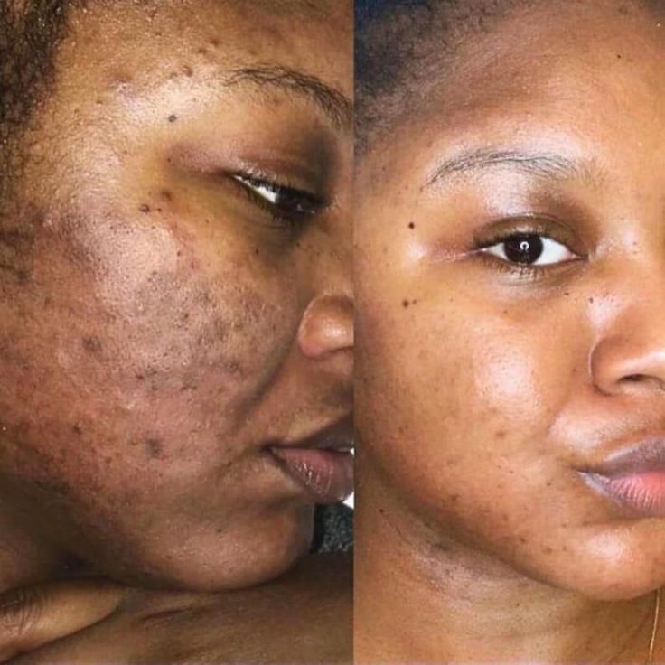 Antes e depois - Joana T.